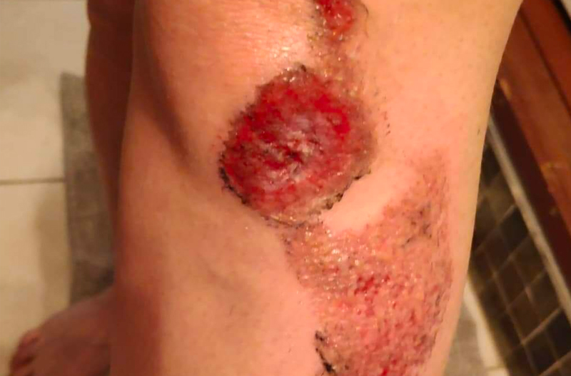 blessure a moto